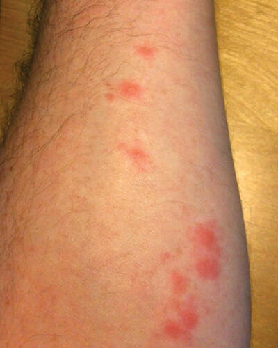 bed bug bites