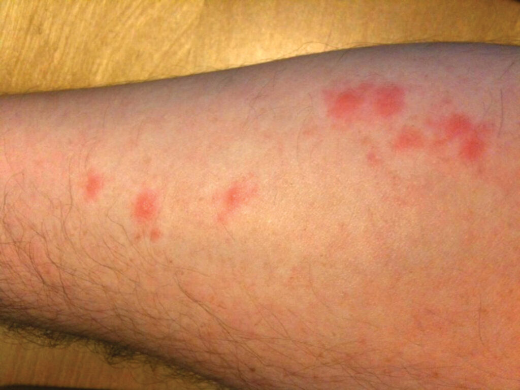bed bug bites on male forearm