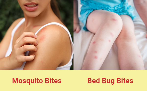 bed bug vs flea bites