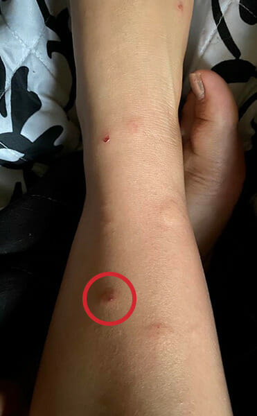 Leg with multiple flea bites near ankle